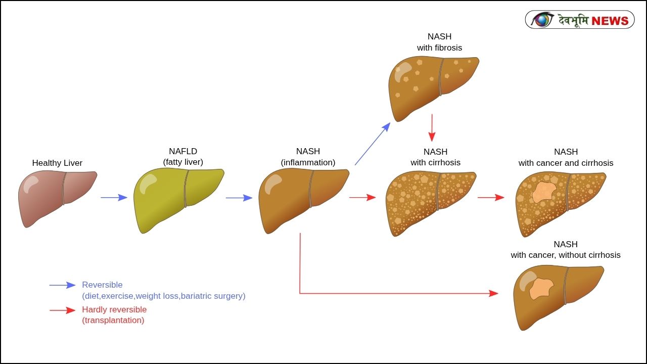 DELHI GIRL LIVER FAILURE MOMOS